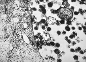 F, 79y. | paraganglioma … intestinal serosa F, 79y. | paraganglioma … intestinal serosa